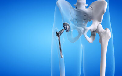 Understanding Hip Replacement: Reasons, Types, Outcomes, and Therapeutic Strategies